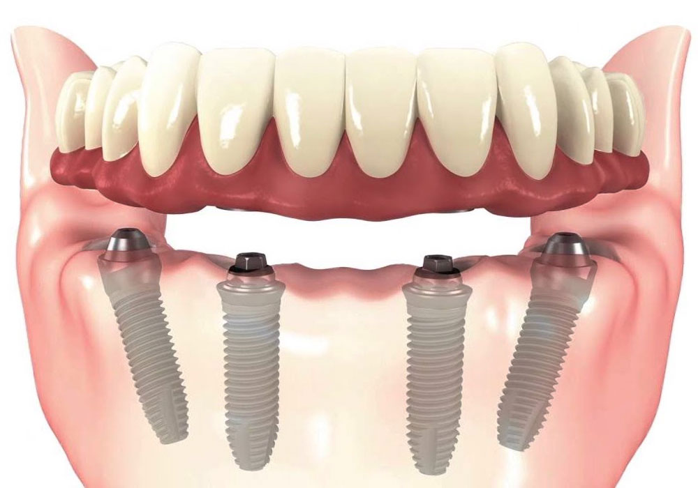 Hybrid Prosthesis The Lab Guys USA