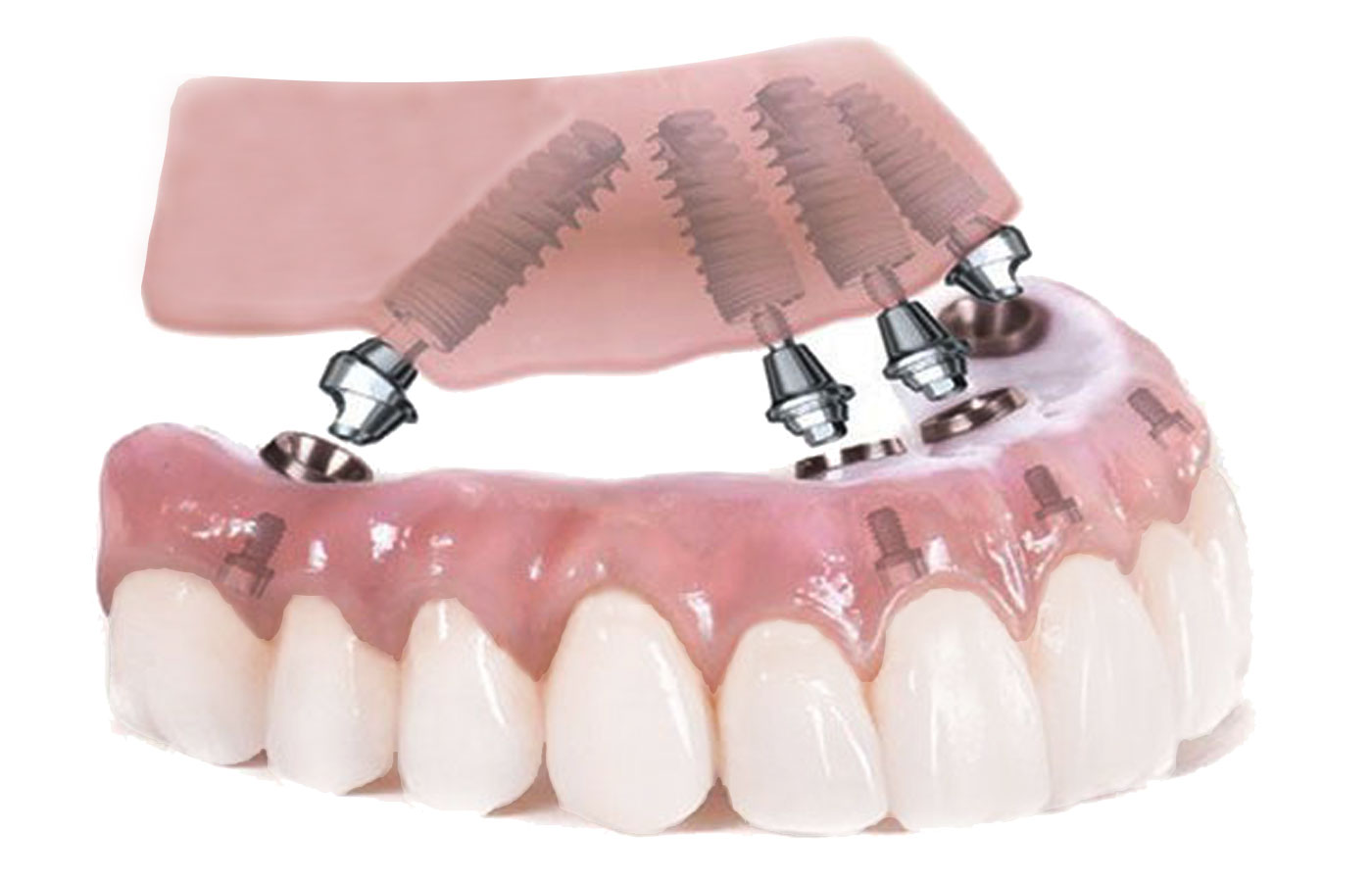 Hybrid Prosthesis The Lab Guys USA